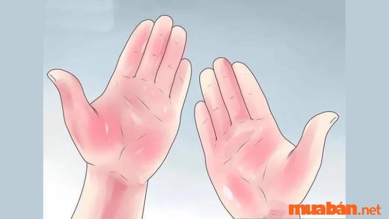 Lòng bàn tay đỏ mang những dấu hiệu gì trong sức khỏe và phong thủy?
