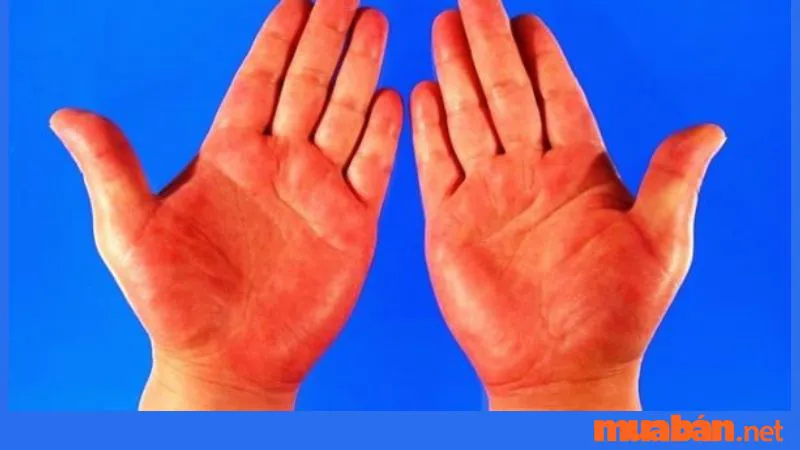 Lòng bàn tay đỏ mang những dấu hiệu gì trong sức khỏe và phong thủy?